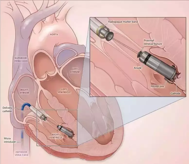全國首批！遼西首例！葫蘆島市第二人民醫(yī)院心臟中心完成遼西首例Micra AV無導(dǎo)線起搏器植入術(shù)(圖2)